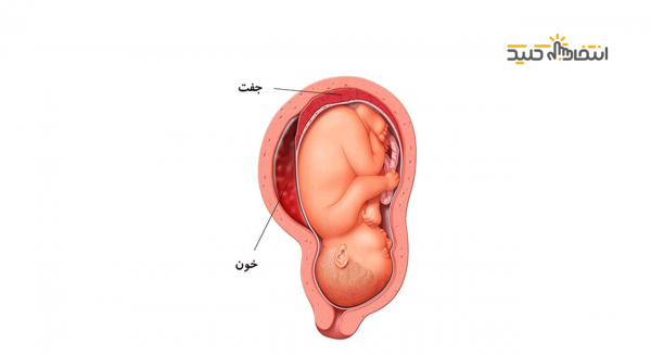 وضعیت جنین در زایمان طبیعی